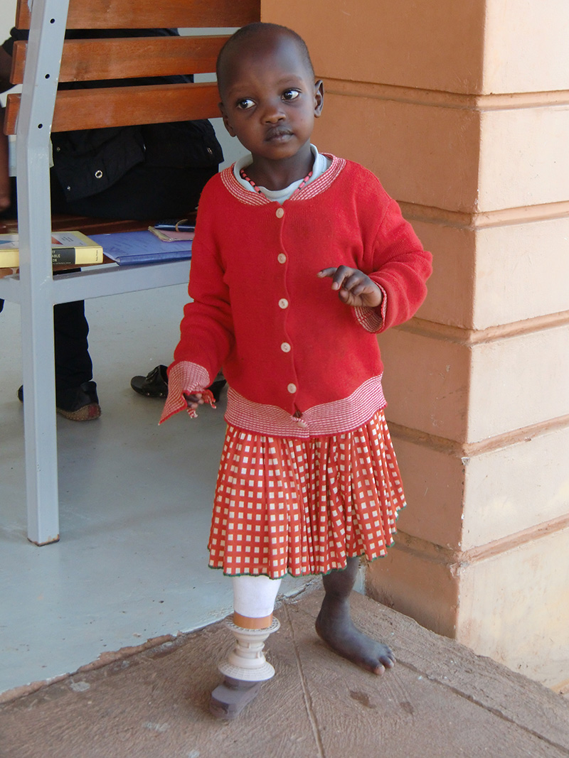 Roseline, the first patient to receive a custom 3D printed prosthetic from Nia Technologies. (Photo: Nia Technologies)