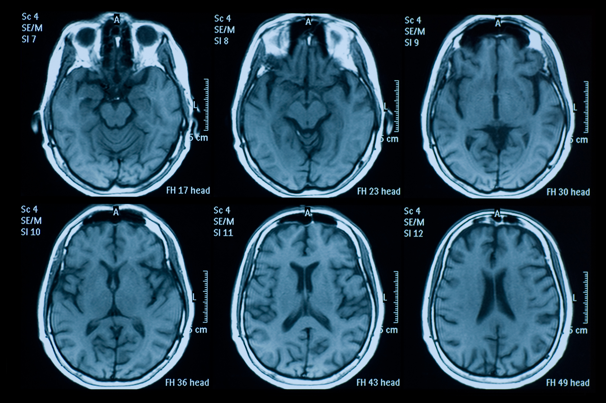 An MRI of a brain